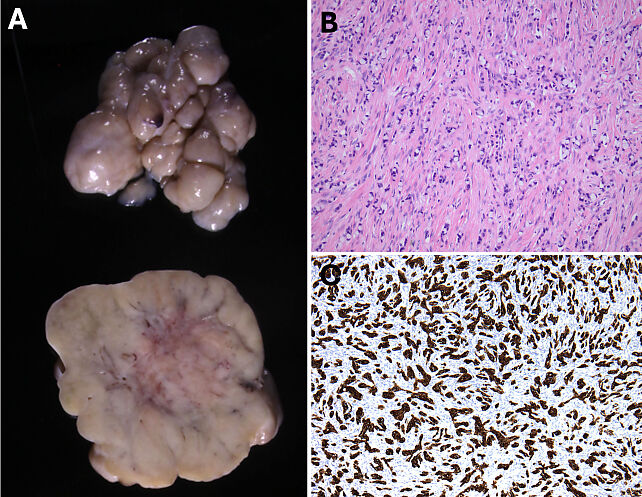 organ 写真集 Pathology of Ovarian, Fallopian Tube and Primary Peritoneal